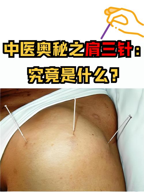 肩周炎针灸特效穴位集锦