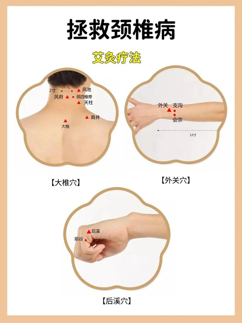 颈椎增生 骨刺艾灸穴位