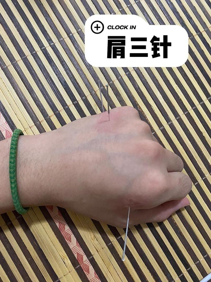 针灸哪些穴位治疗肩周炎