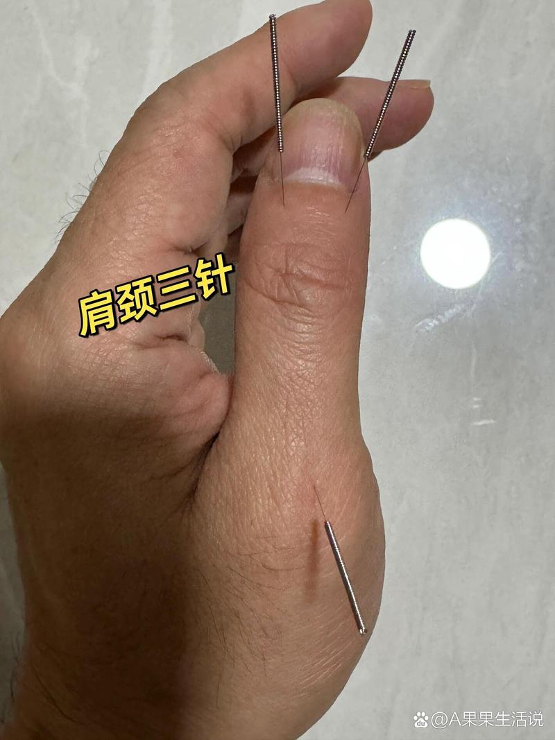 针灸哪些穴位治疗肩周炎