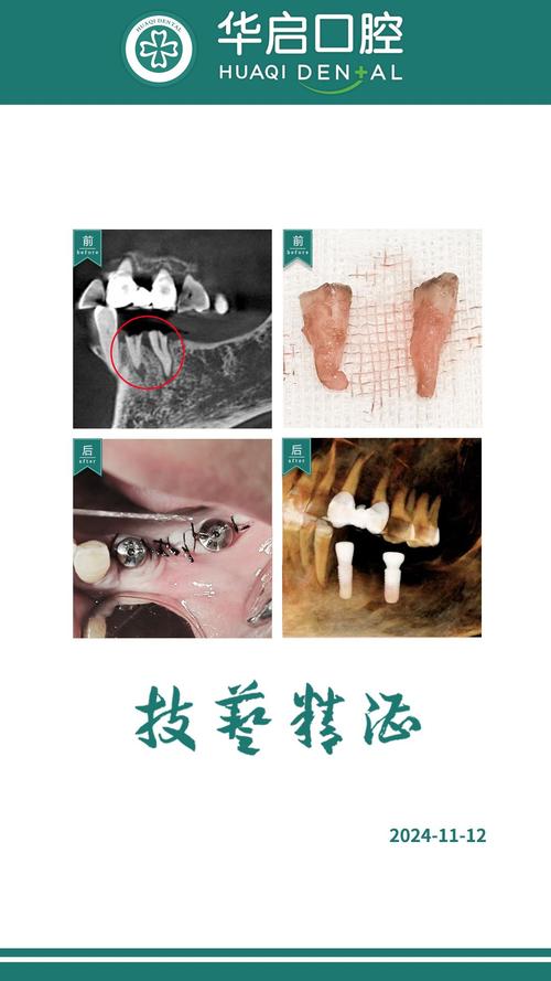 穴位 拔牙 农村 种牙