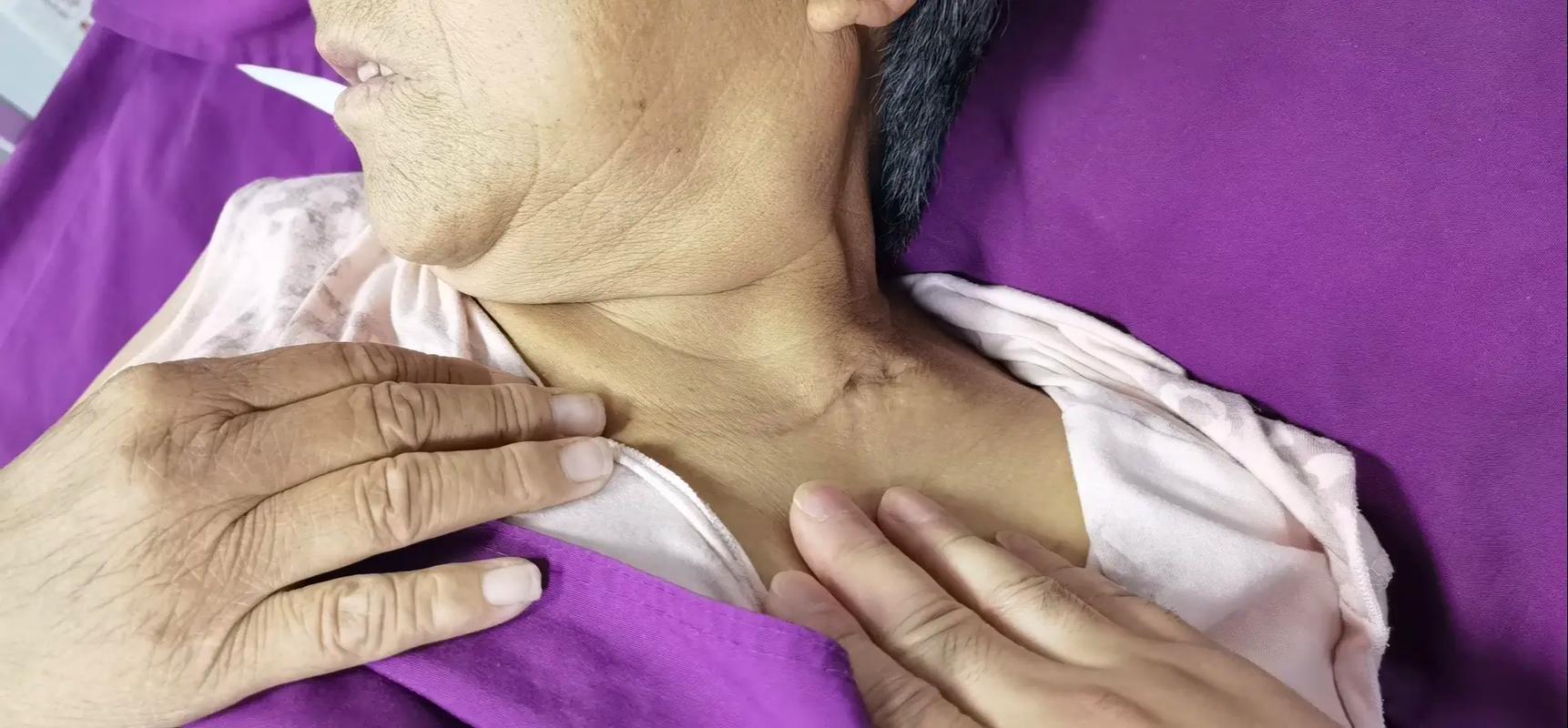 淋巴结核中医怎么治疗