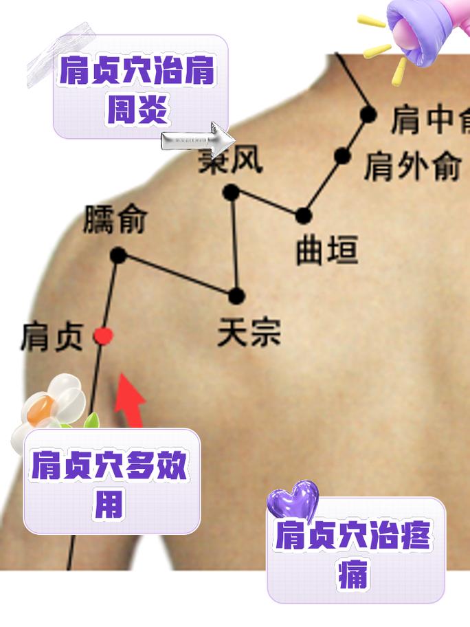 肩周炎哪个针灸穴位更好