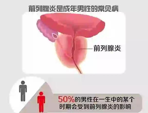 前列腺炎看中医什么科