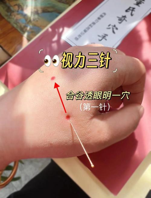 西医 近视 穴位 研究