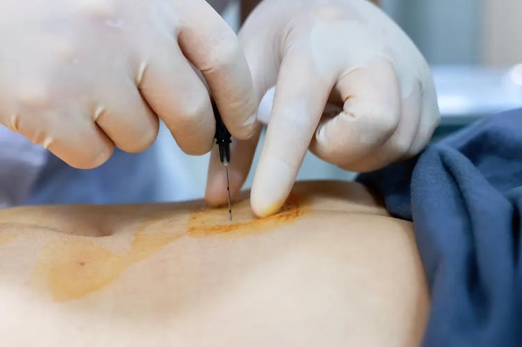 江西省中医院埋线减肥