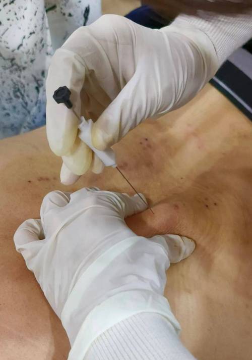 江西省中医院埋线减肥