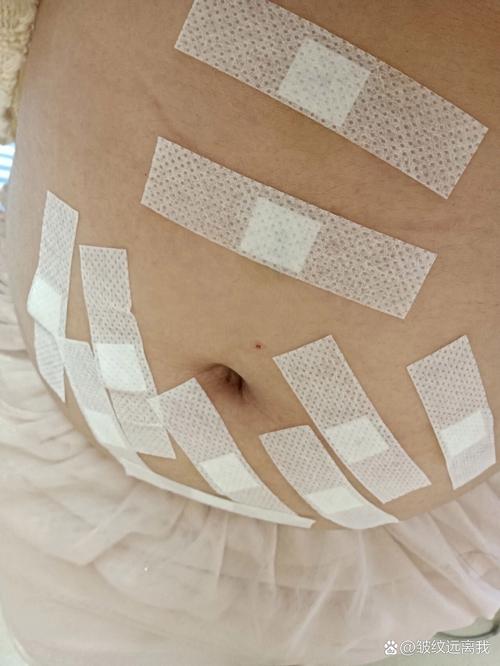 江西省中医院埋线减肥