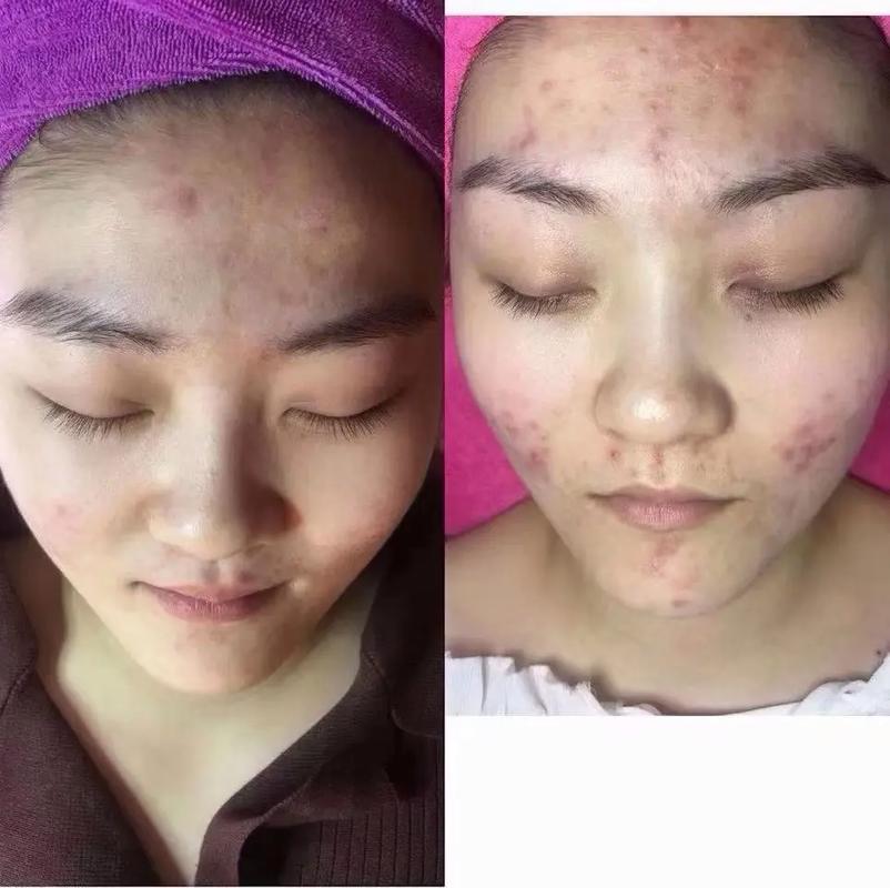 老中医祛痘霜有效果吗