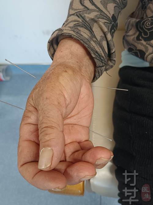 言语不清 针灸穴位