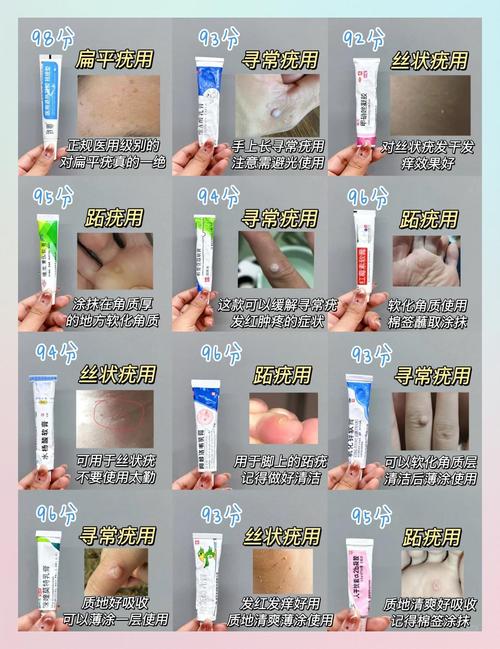 治疗扁平疣的中医药膏