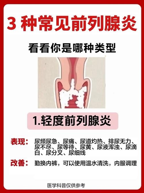 中医治疗前列腺炎案例