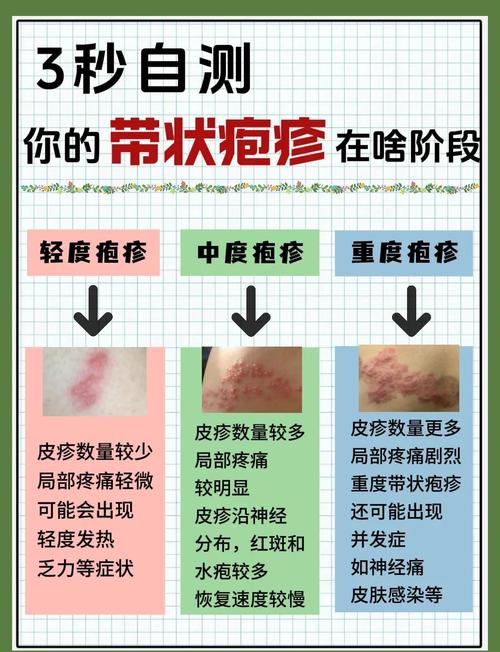 带状疱疹的治疗方法和饮食