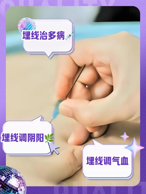 穴位埋线会不会破坏穴位