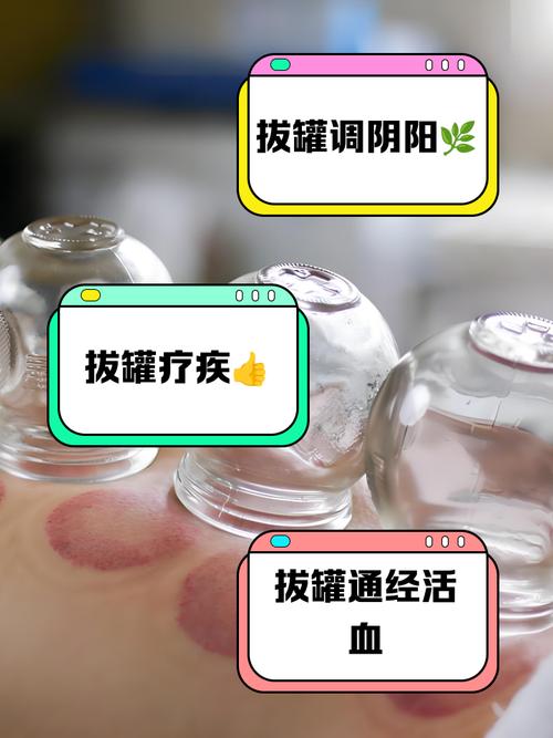 拔罐拔什么穴位治盆腔炎