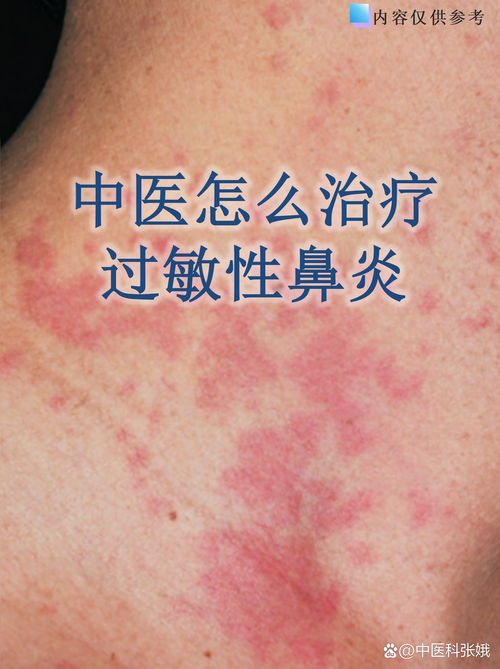 中医能治好过敏性鼻炎