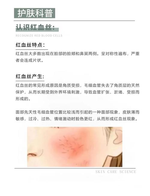 中医能调理好红血丝吗