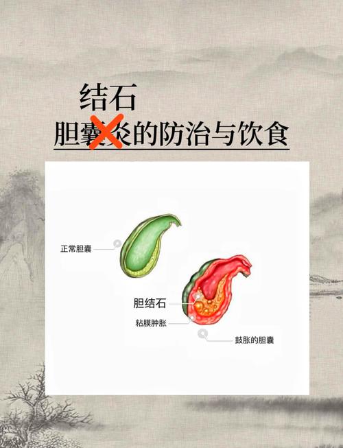 胆结石应该怎么饮食调理