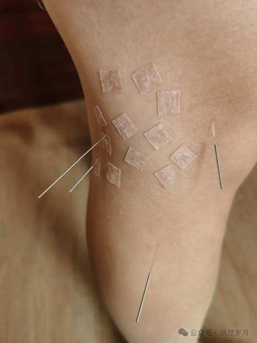 小腿外侧麻木针灸穴位