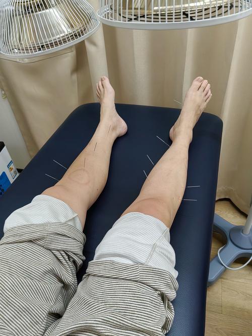 小腿外侧麻木针灸穴位