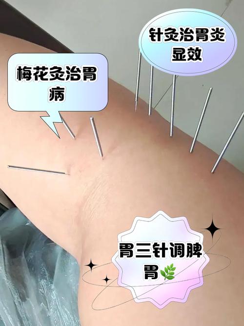 肠炎胃炎针灸什么穴位