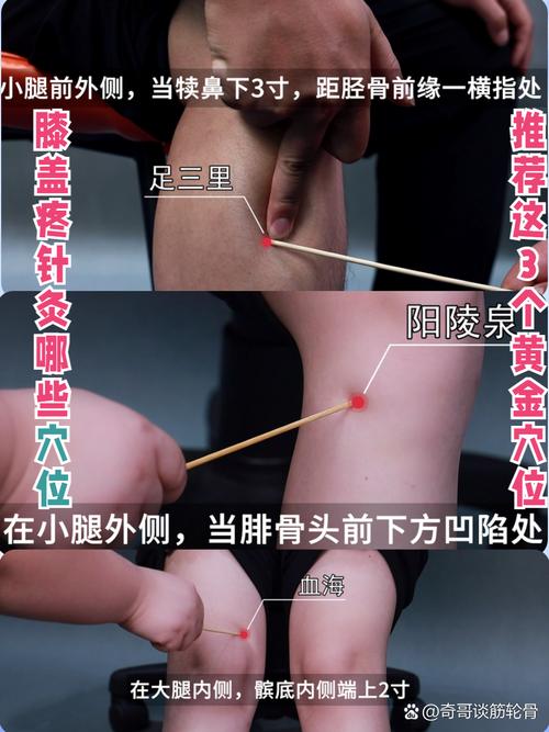 针灸 腘窝疼痛 穴位
