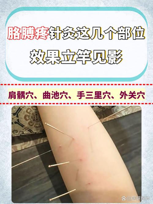 针灸 腘窝疼痛 穴位