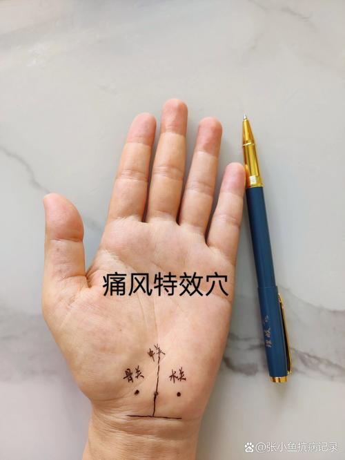 治疗痛风还有哪些穴位