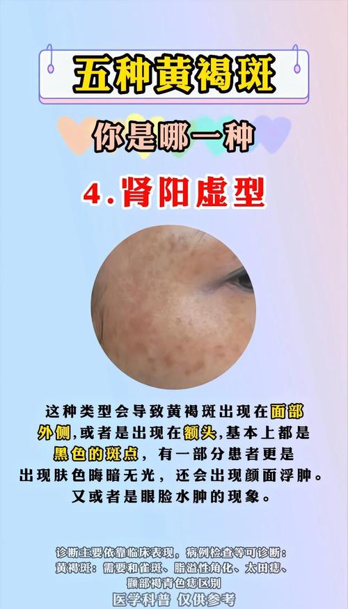 北京看黄褐斑好的中医