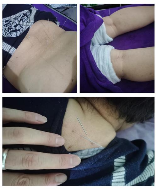 治疗腰椎滑脱针灸穴位