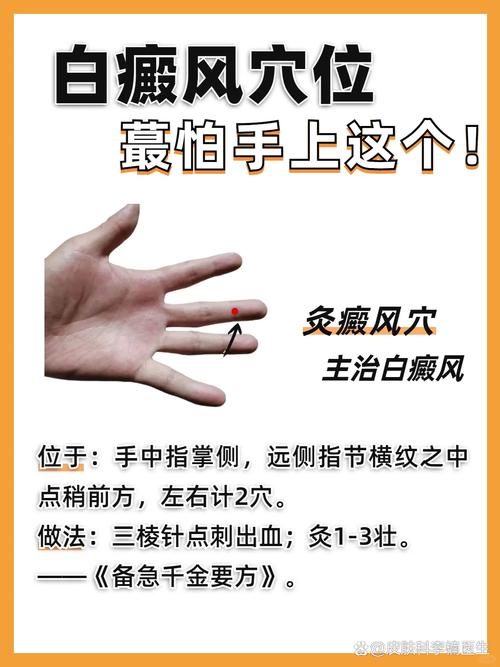 用艾灸疗法白癜风穴位