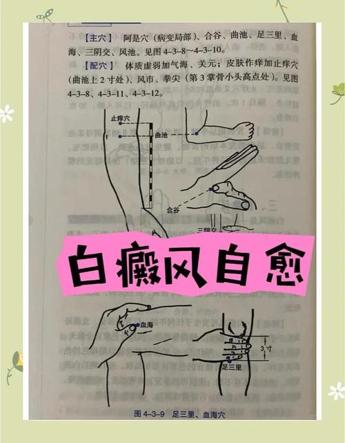 用艾灸疗法白癜风穴位