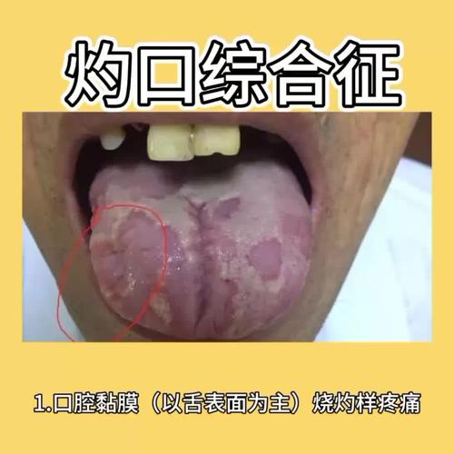 灼口综合症中医叫什么