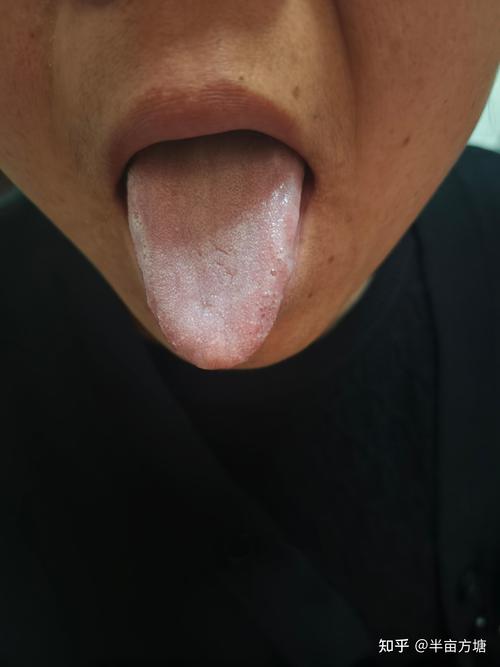 灼口综合症中医叫什么