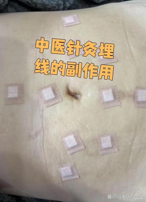 中医埋线的线有副作用