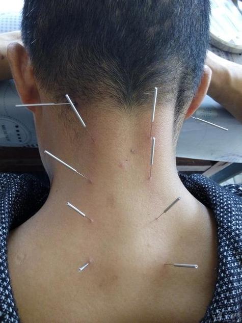 颈椎不好针灸什么穴位