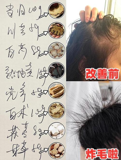 中医治脱发的奇方妙方