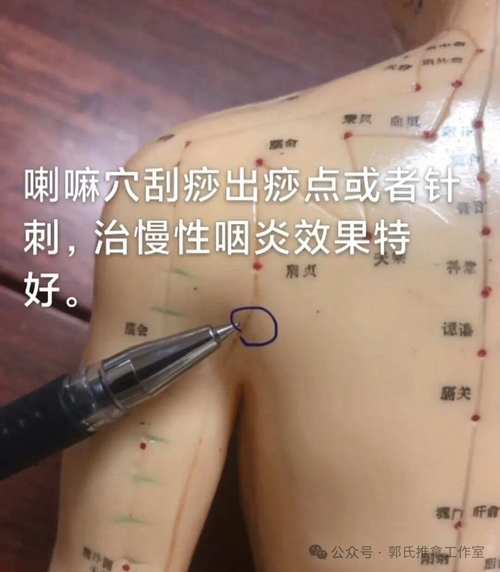 急性咽炎穴位治疗方法