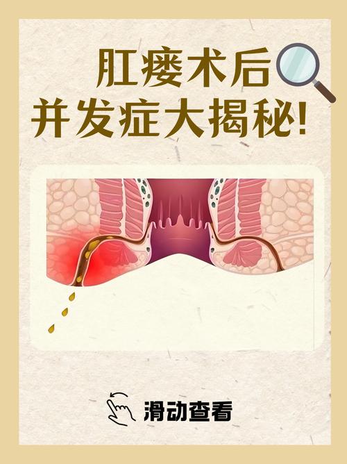 中医院怎么做肛瘘手术