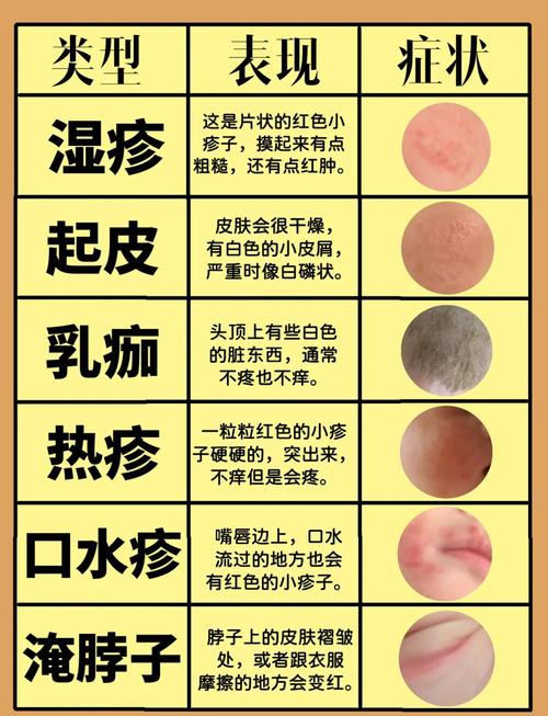 湿疹宝宝饮食注意什么好