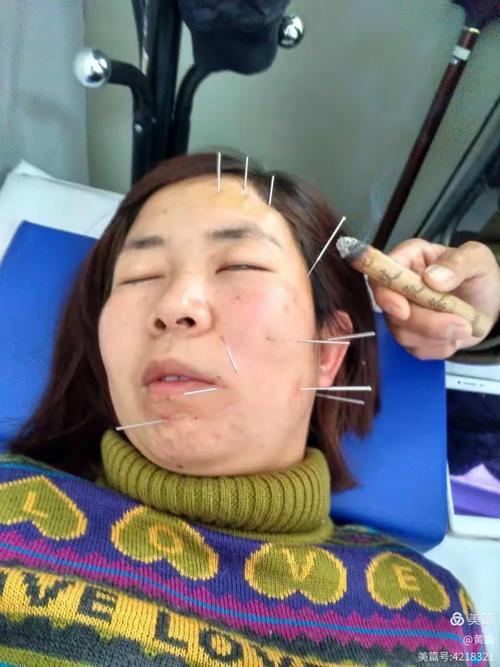 面瘫穴位注射效果好吗