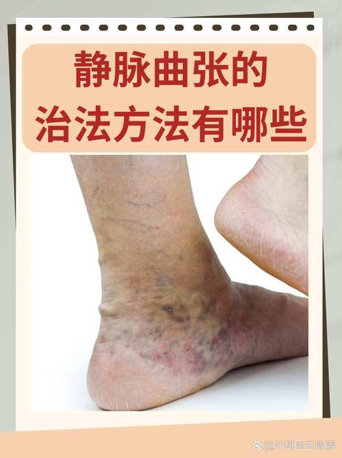 下肢静脉曲张中医病名
