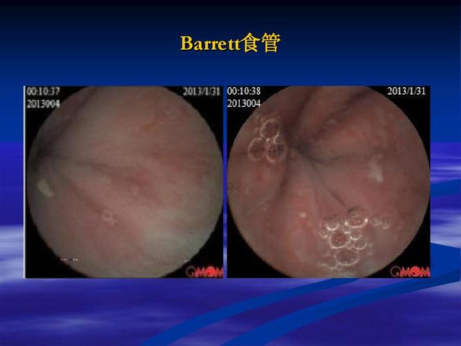 barret食管饮食