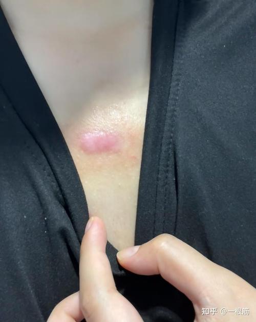 瘢痕疙瘩穴位按摩视屏