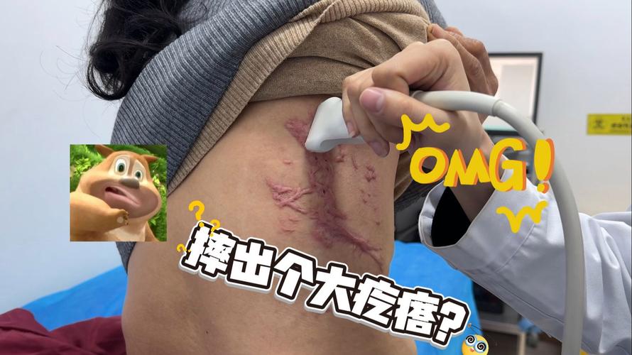 瘢痕疙瘩穴位按摩视屏