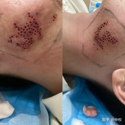 瘢痕疙瘩穴位按摩视屏