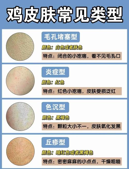 鸡皮肤中医上怎么治疗