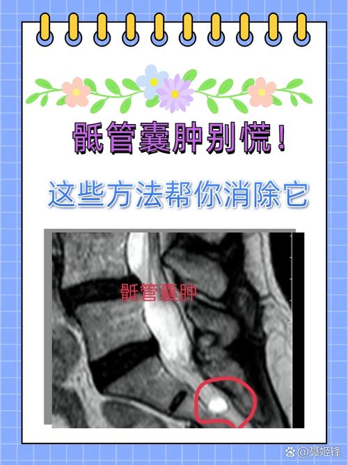中医如何治疗骶管囊肿