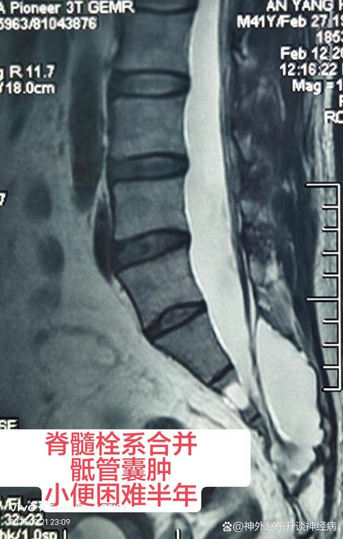 中医如何治疗骶管囊肿