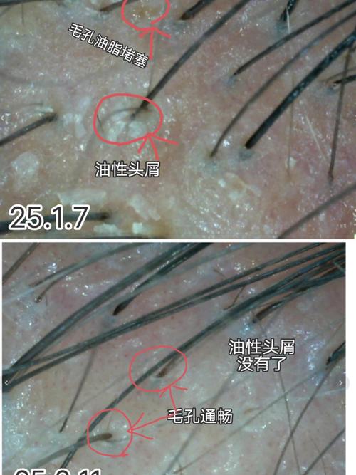 微信张老师中医去头屑